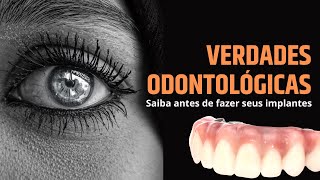 IMPLANTES DENTÁRIOS  Saiba Definir o Que Você Procura [upl. by Irv]