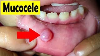 How to cure Mucocele  Home Remedies for a Mucocele [upl. by Merill]