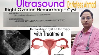 Ultrasound Right Ovarian Hemorrhagic Cyst doctor motivation viral ultrasound treatment [upl. by Bogie401]