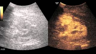 Nierenultraschall [upl. by Kersten]