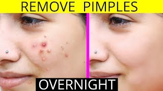 How To Remove Pimples Overnight  Acne Treatment  Anaysa [upl. by Irene126]