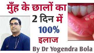 Mouth Ulcers ka complete treatment in just 2 days supradynfoviteomnacortilkenacort geldr bola [upl. by Vasos]