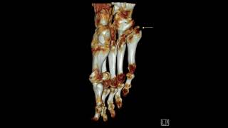 5th metatarsal base fracture [upl. by Orapma448]