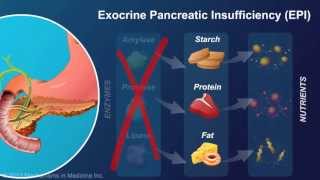 Exocrine Pancreatic Insufficiency [upl. by Kory529]