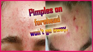 PimplesAcne on Forehead Causes amp Treatment [upl. by Vic]