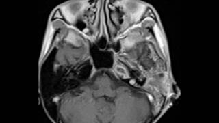 Petrous Apex Abscess [upl. by Nraa]