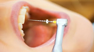 Endodontics The Key to Saving Your Teeth  What Is It and How Can It Help [upl. by Ekyt662]