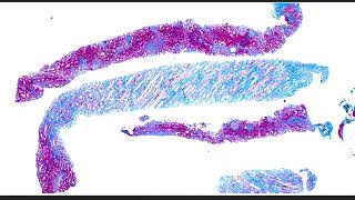 Collidescope Ep 1  What happens when IgA nephropathy and fibrillary glomerulopathy collide [upl. by Madelon356]