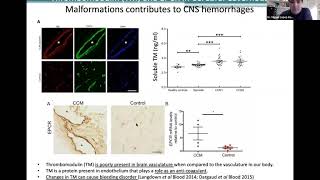 Blood thinners and Cerebral Cavernous Angioma Cavernoma Cavernous Malformation [upl. by Zoilla]