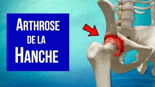 Arthrose de la hanche  Explication et Traitement [upl. by Oel]