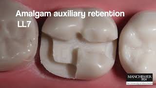 Amalgam auxiliary retention LL7 [upl. by Ruelu]