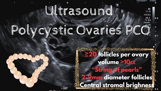 Ultrasound Polycystic Ovaries PCO criteria [upl. by Pippa192]