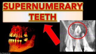 How to Make Sure it is a Supernumerary Tooth Extra teeth in mouth hyperdontia extra front teeth [upl. by Ahsirtal485]