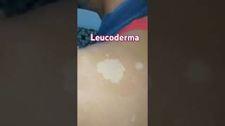 Leucoderma visit Anm herbal health and skincare clinic Lucknow 📞 9235735335 [upl. by Jacobina]