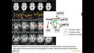 7 Heterotopia epilepsy PVNH malformation cortical development filamin CDK5 MRI neuroradiology [upl. by Zirkle238]