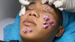 Big Cystic Acne Blackheads Extraction Blackheads amp Milia Whiteheads Removal Pimple Popping 081 [upl. by Neile]