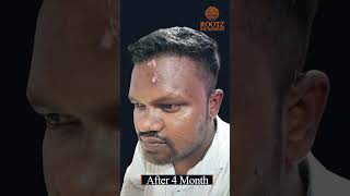 Hair Transplant Results after 4 months  Hair Transplant Before amp After Results  Dr Soumy Pandey [upl. by Gruver]