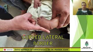 Congenital Talipes Equino Varus  Clinical Orthopaedics  Dr Prateek Joshi M S  MEDUSANE [upl. by Atsiuqal419]