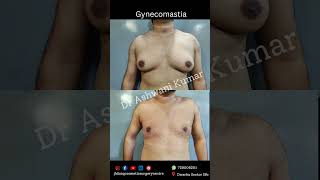 Gynecomastia surgery results day 3 [upl. by Beauchamp844]