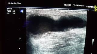 Galactocele Ultrasound [upl. by Rodie531]