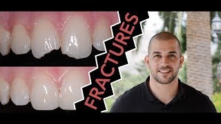 How to Repair a Broken Tooth with Dentist Filling Dentist [upl. by Barri]