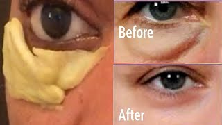 EASY REMEDY TO REMOVE EYE BAG AND PUFFY EYE FAST [upl. by Eanom465]