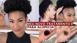 NOVO TRATAMENTO PARA ALOPECIA  COMO PAREI MINHA QUEDA DE CABELO • Patt Neves [upl. by Luapnhoj]