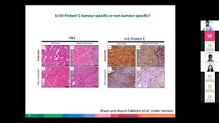 Translational Analysis of Yttrium90 Treatment in Hepatocellular Carcinoma [upl. by Ekalb]