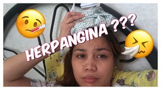 HERPANGINA SYMPTOMS AND TREATMENT [upl. by Berriman]