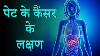 ये लक्षण नजर आए तो समझो पेट का कैंसर है  colon cancer  colon cancer treatment [upl. by Gianna313]