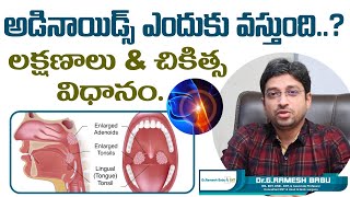 అడినాయిడ్స్ ఎందుకు వస్తుంది  Adenoids or Adenoid Hypertrophy Treatment  Dr Ramesh Babu ENT [upl. by Akkin]