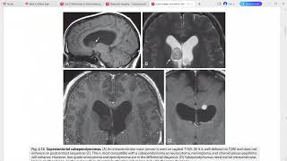 CORE REQUISITES of neuroradiology [upl. by Charteris]