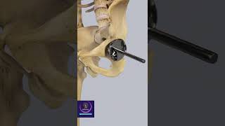 Total Hip Replacement Orthopedic Surgery 3D Animation [upl. by Atsed390]