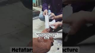 Metatarsal Bones Fracture Treatment by Dilshad Khan [upl. by Gayler]