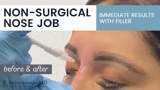 NonSurgical Nose Job Live Nose Filler Procedure [upl. by Aneema974]