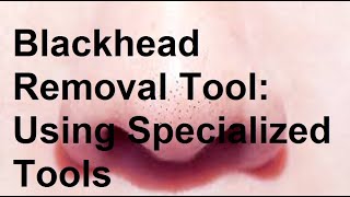 Blackhead Removal Tool Using Specialized Tools Like a Comedone Extractor [upl. by Noemad661]