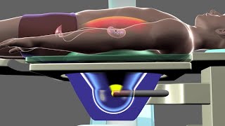 Shockwave Lithotripsy [upl. by Ateinotna308]