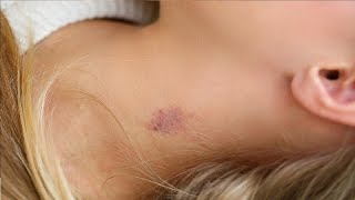 easiest way to give a hickey in 3 minutes [upl. by Dev]