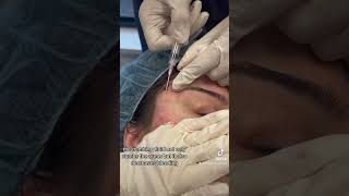 Subcision for Acne Scars of the Cheeks and Temples [upl. by Cloots970]