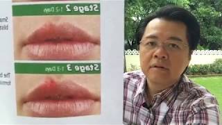 Sakit sa Balat Butlig Cold Sore Pigsa Maitim na Balat  Payo ni Doc Willie Ong 569 [upl. by Deming]