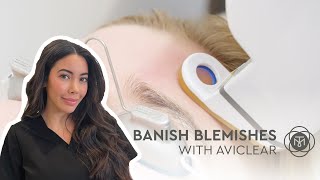 AviClear Acne Laser in NYC  Banish Blemishes with Tribeca Medspa [upl. by Ashla]