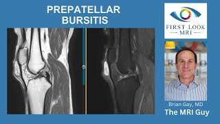 Prepatellar Bursitis [upl. by Siugram892]