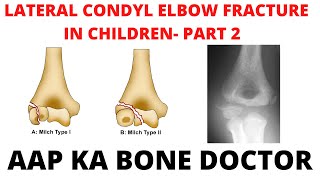 LATERAL CONDYL ELBOW FRACTURE IN CHILDREN PART 2 EPISODE 40 [upl. by Burch]