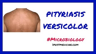 Pityriasis Versicolor  Microbiology [upl. by Card]