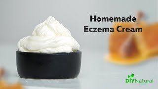 DIY Eczema Cream A Homemade Natural Solution That Works [upl. by Ahsina]