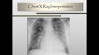 Chest XRay Interpretation [upl. by Cj]