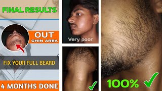 BEARD GROWTH  FIX YOUR FULL BEARD  Final results of 4 months  How to grow full beard minoxidil [upl. by Lucey]