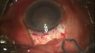 OneMinuteOphthalmology  Effective Use of Cautery in SICS SurgicalSaturday [upl. by Ynaffit]