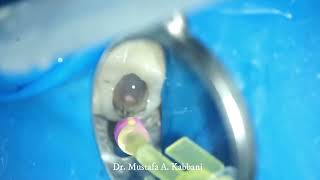 Retrieval Of OverExtended GuttaPercha Under The Microscopic Magnification Dr  Mustafa Kabbani [upl. by Eki343]