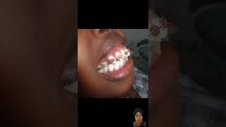 Danto ko theek karne ka Tarika dental dentalesthetics [upl. by Tamarah]